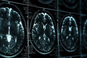 New Hope for TBI Treatment